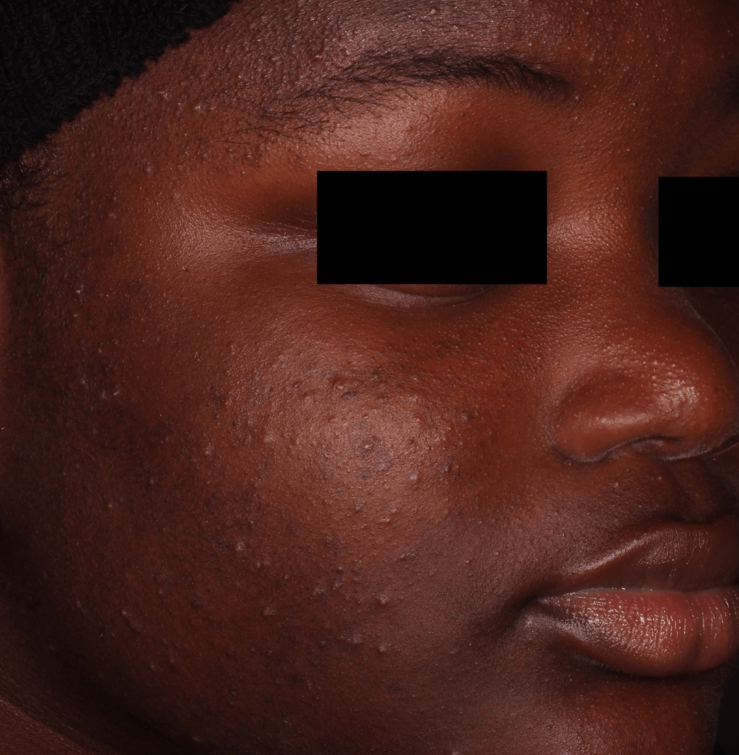 Before-and-after image of CABTREO patient