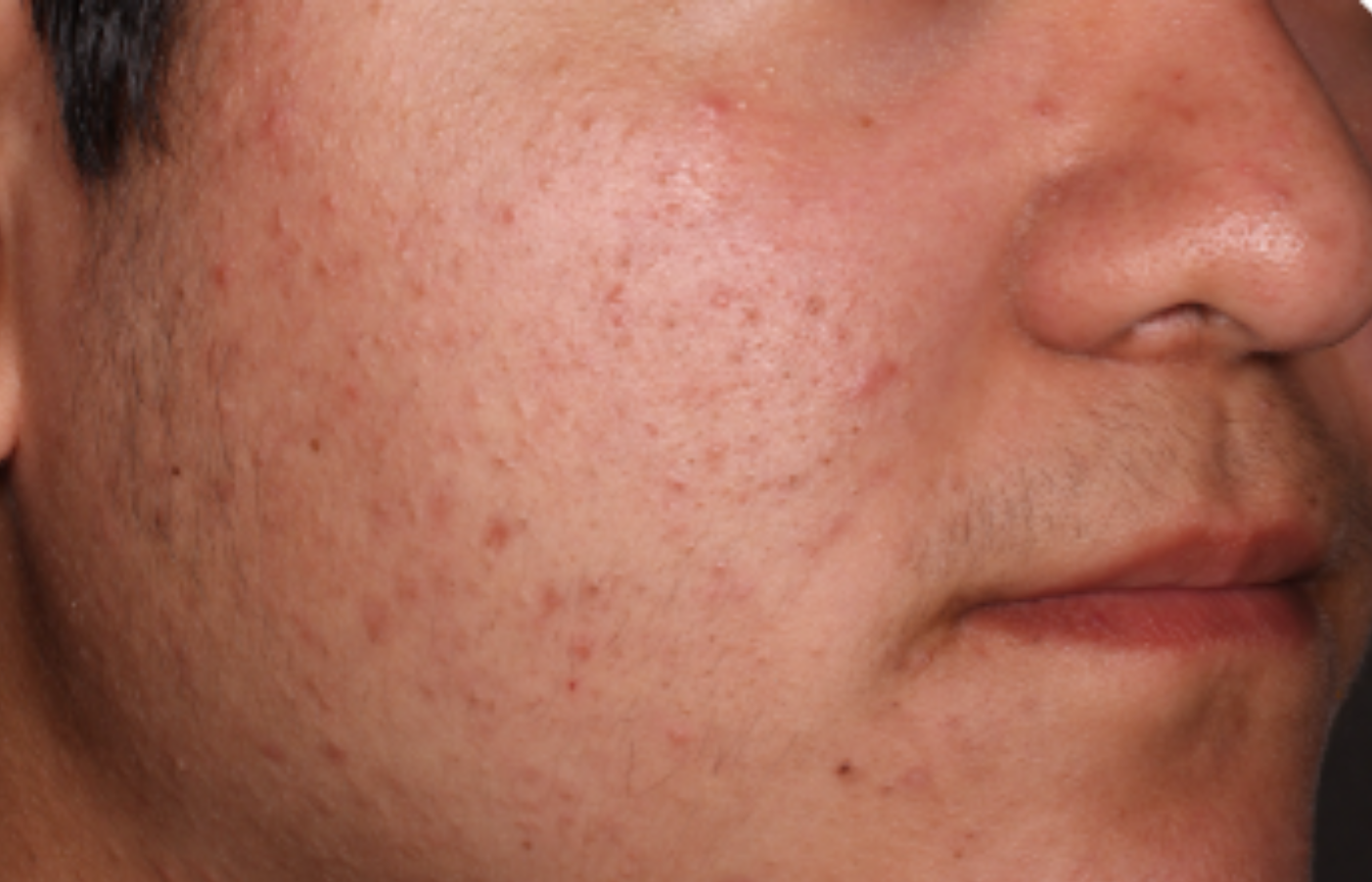 Before-and-after images of a CABTREO patient