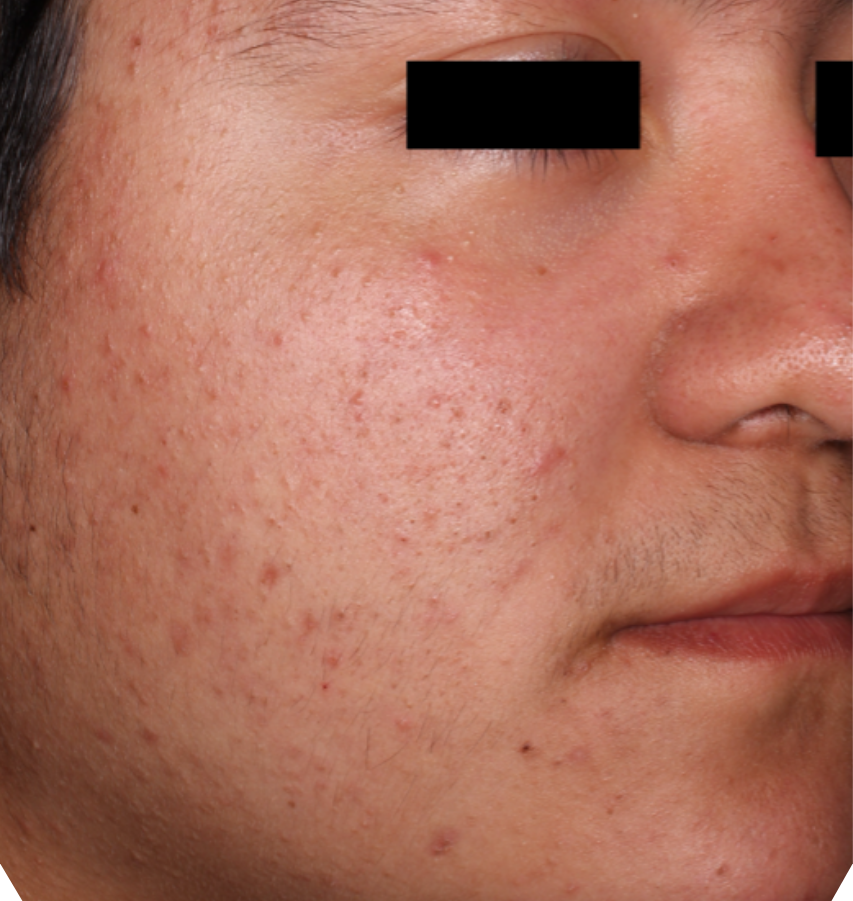 Before-and-after image of CABTREO patient