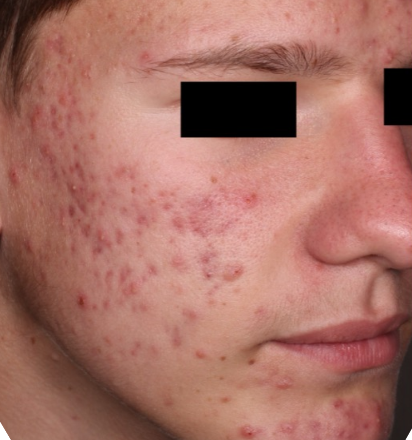 Before-and-after image of CABTREO patient