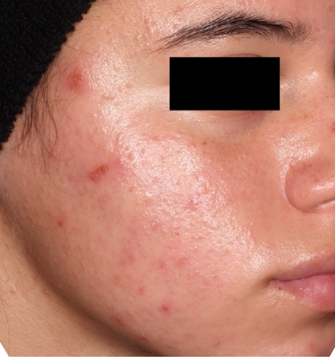 Before-and-after image of CABTREO patient