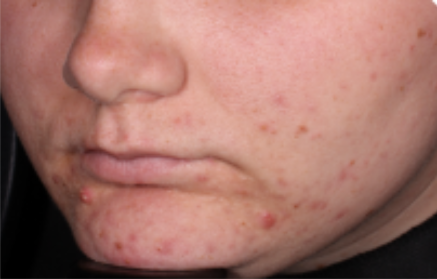 Before-and-after images of a CABTREO patient