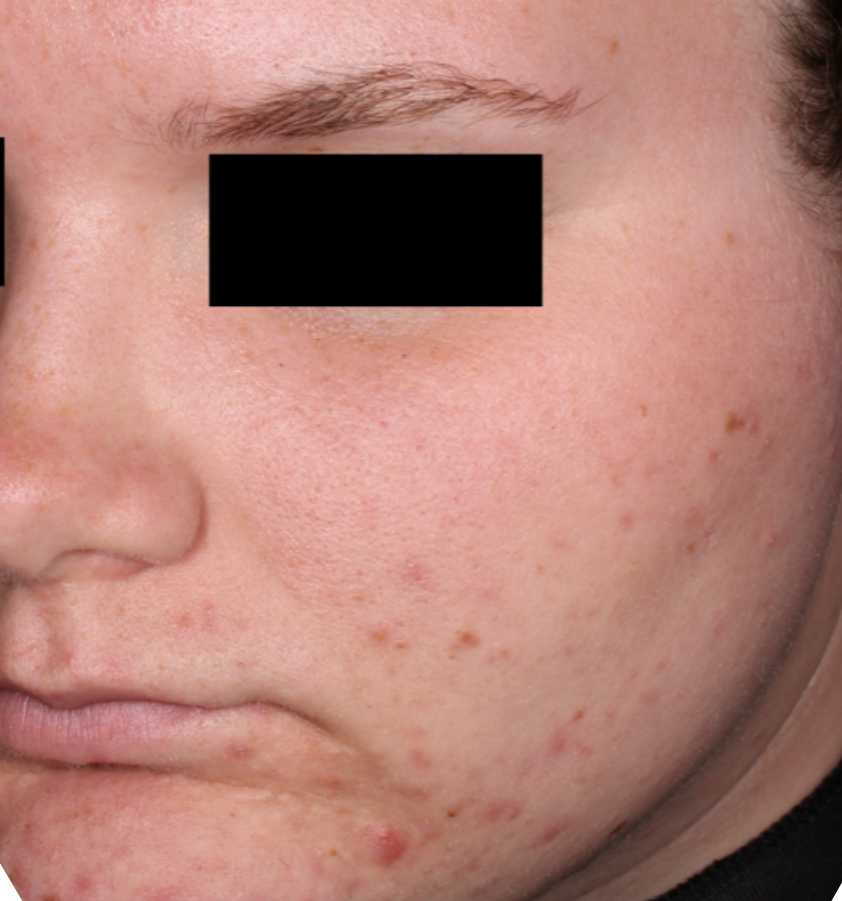 Before-and-after image of CABTREO patient